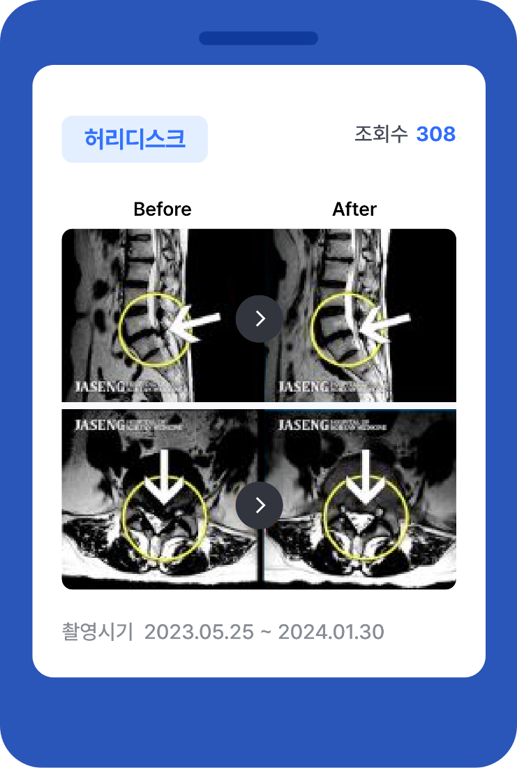 mri 허리디스크 치료결과 before ,afeter 